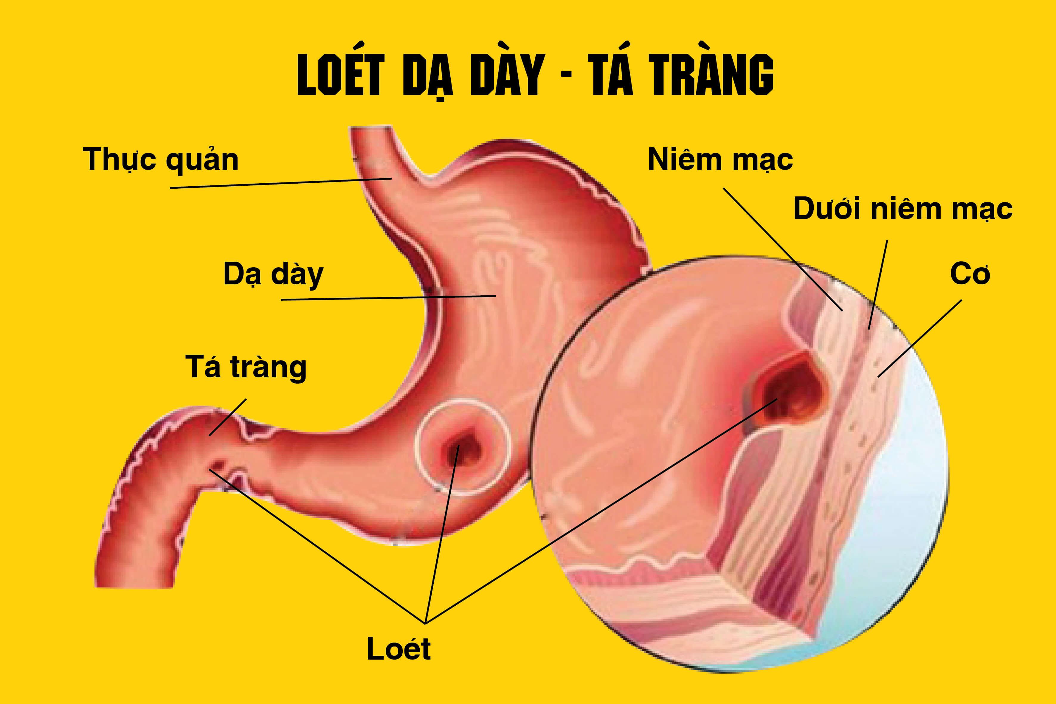 Viêm loét dạ dày là gì