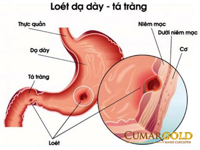 Viêm loét hành tá tràng cơn đau thường xảy ra lúc đói