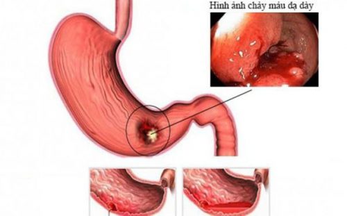 Hậu quả của bệnh viêm loét dạ dày tá tràng nếu để lâu ngày?