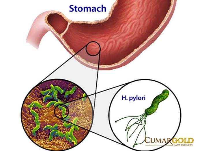 vi khuẩn HP gây viêm loét dạ dày tá tràng
