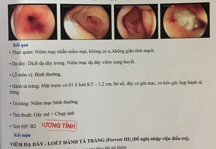 Hình ảnh nội soi cho thấy bé 5 tuổi bị viêm loét dạ dày tá tràng