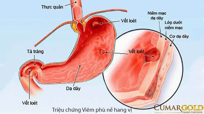 Triệu chứng viêm phù nề hang vị