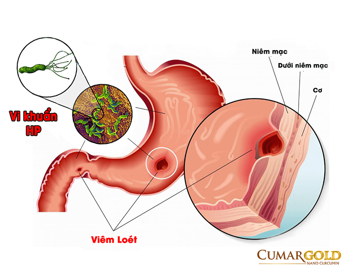 Vi khuẩn HP là loại vi khuẩn chính yếu gây ra những căn bệnh liên quan đến dạ dày