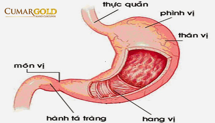 Biến chứng viêm hang môn vị dạ dày 