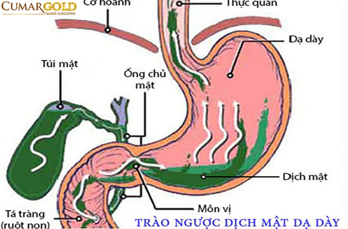 viêm hang vị dạ dày – trào ngược dịch mật gây ra cảm giác nóng rát